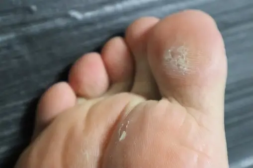 발가락 물집 원인 및 대처방법