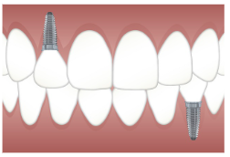 임플란트 가격 특징 정리
