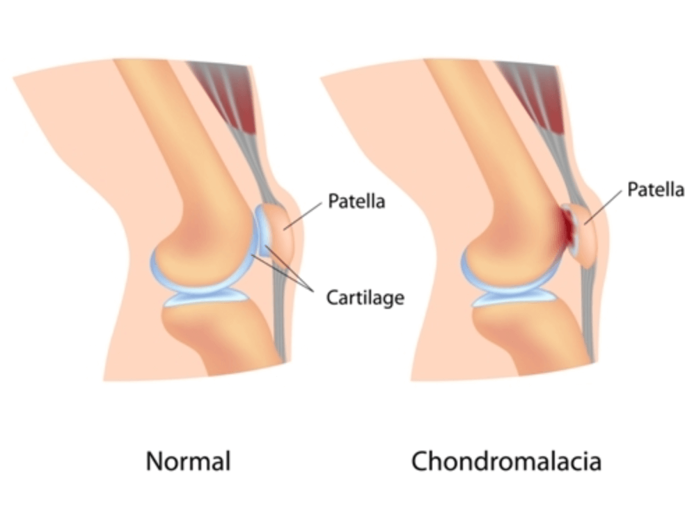 연골연화증 증상