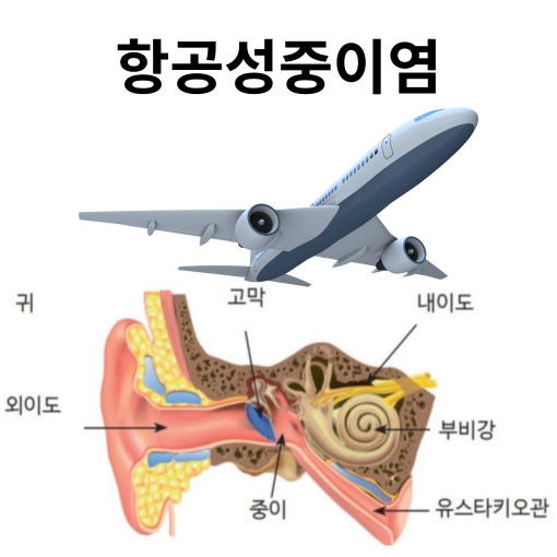 항공성 중이염