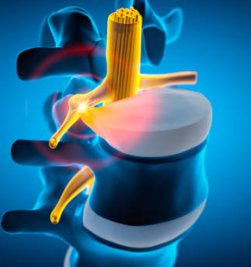 허리디스크 초기