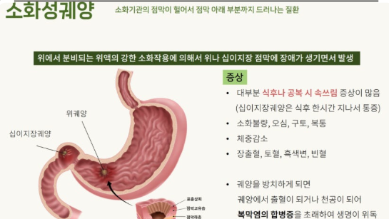 위염과 위궤양의 차이 및 예방법 관련 이미지