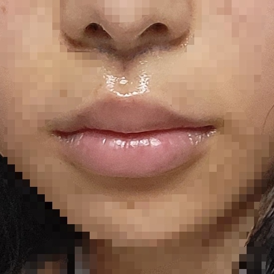 인중 축소 수술 후기