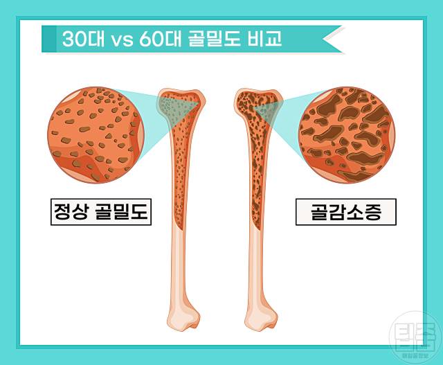 골밀도 높이는 음식 뼈튼튼해지는음식