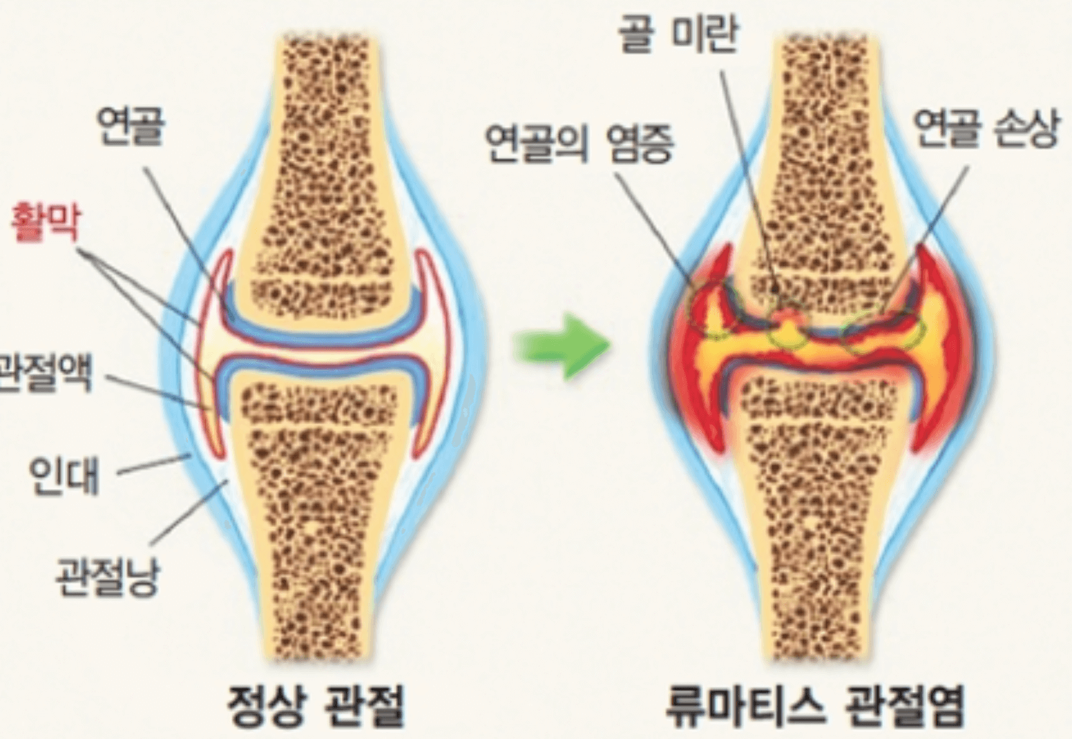 류마티스 관절염 초기증상