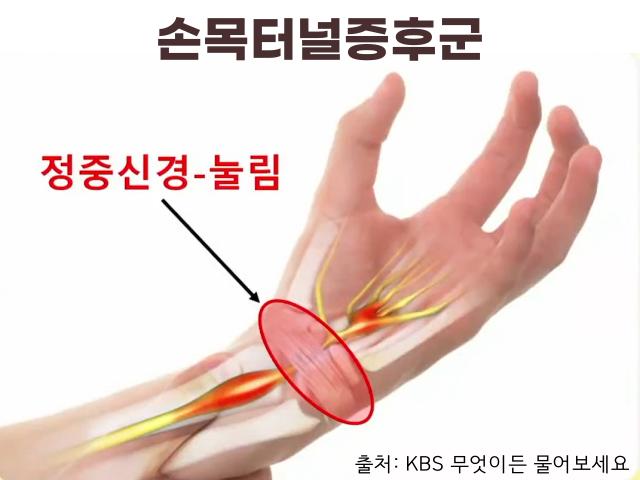 엄지손가락 관절 욱신 통증 자가진단 손목터널증후군