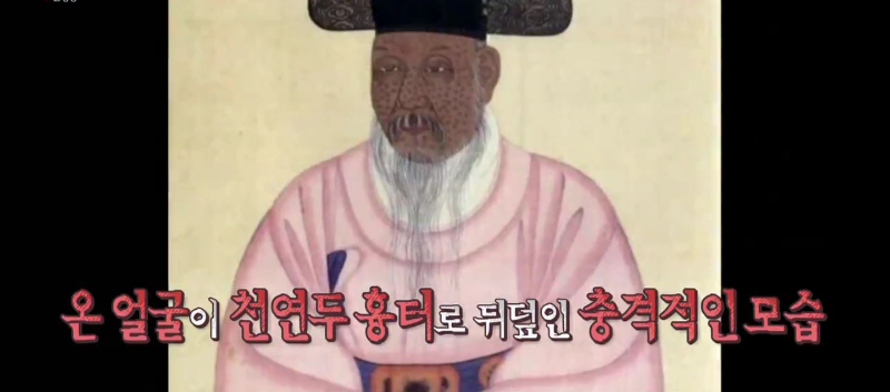 영조때 우의정도 천연두를 앓았던 그의 모습