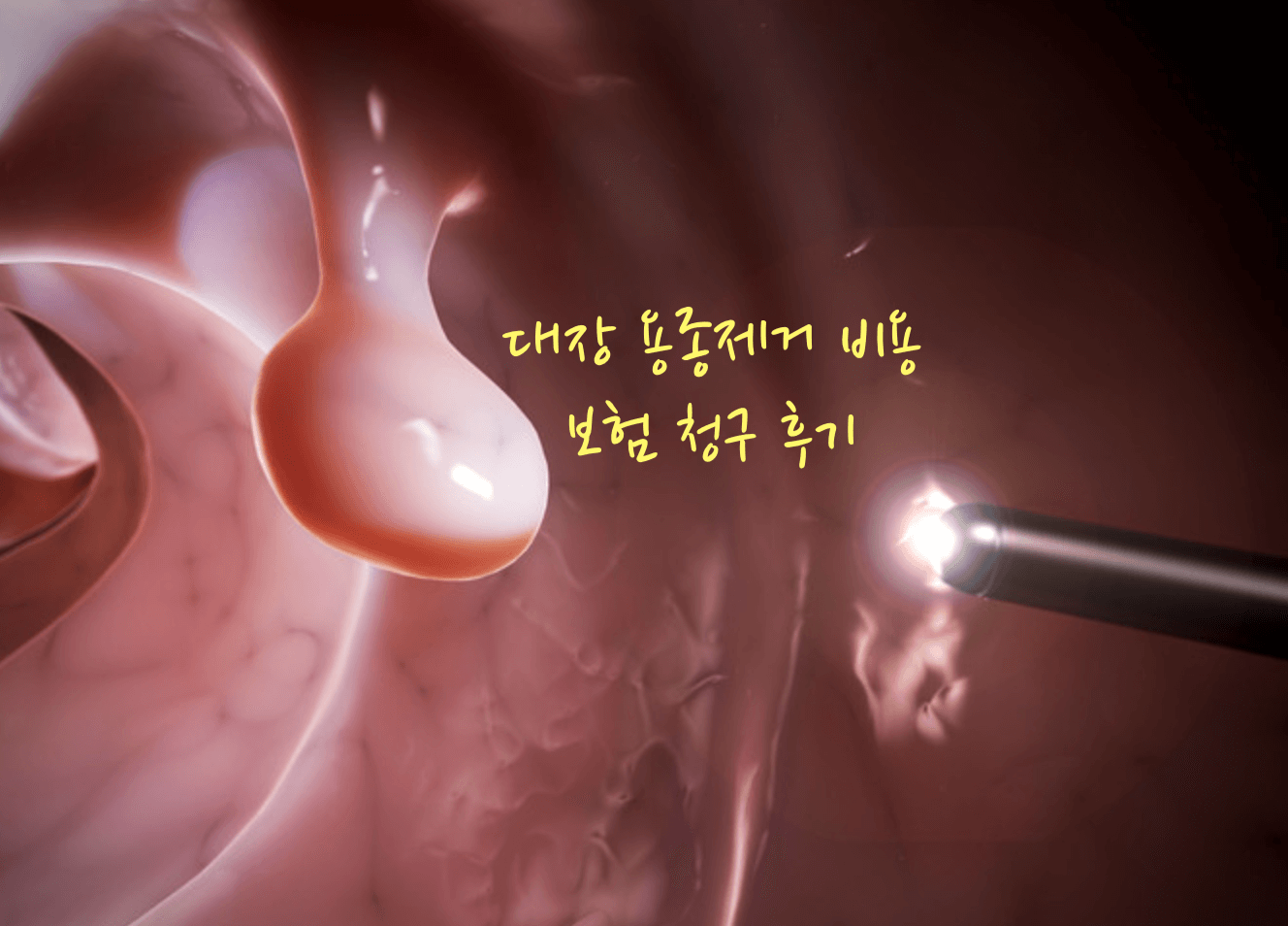 대장 용종제거