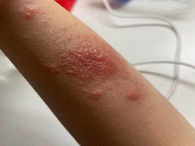 염증 수치 낮추는 방법 10가지