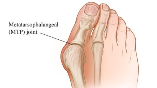 무지외반증 환자 발