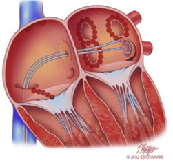 부정맥-종류에-따른-치료법-비교