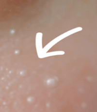 눈밑에 하얀 좁쌀