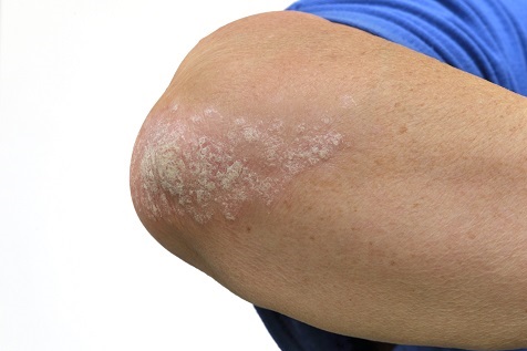 건선 증상이 나타난 팔
