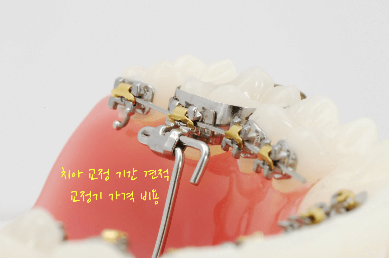 치아 교정 견적