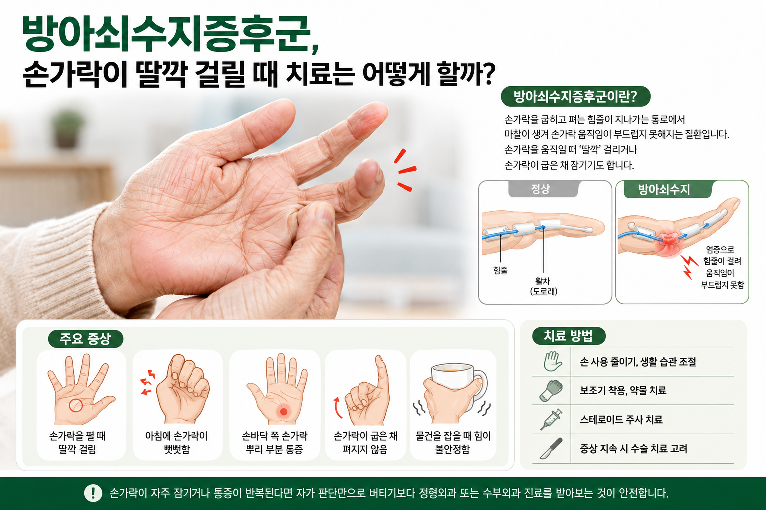방아쇠수지증후군