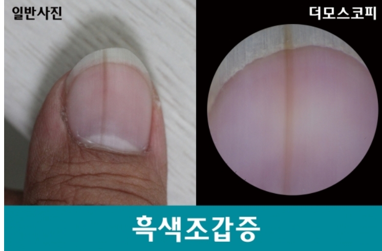 흑색 조갑증 출처 서울대병원