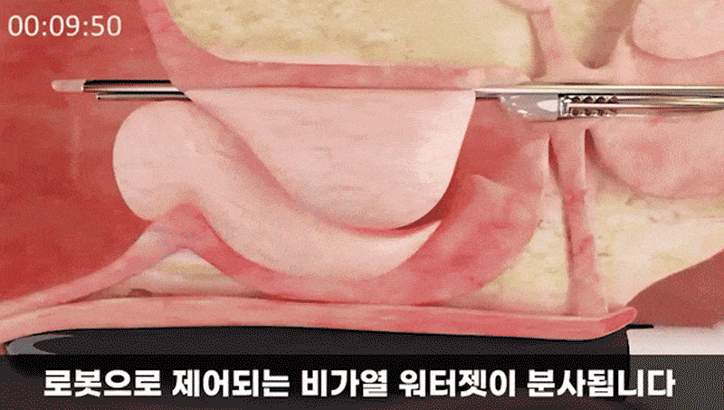 중장년 남성의 절박뇨와 전립선비대증 관련 이미지