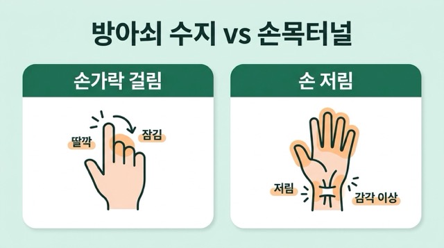 방아쇠 수지와 손목터널증후군 차이