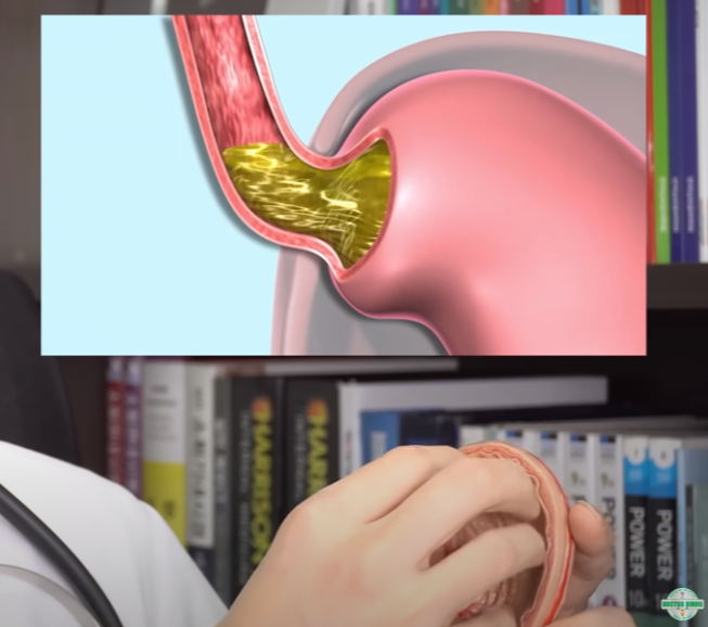 역류성 식도염 정의