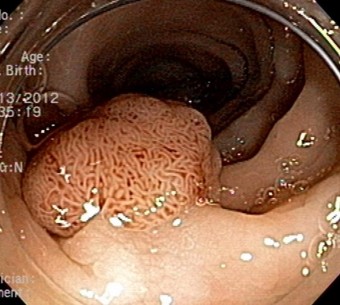 대장암에 좋은 음식 항암식품