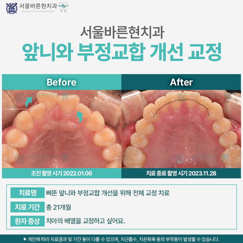 부산치아교정