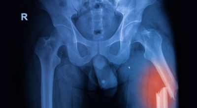 고관절 이미지