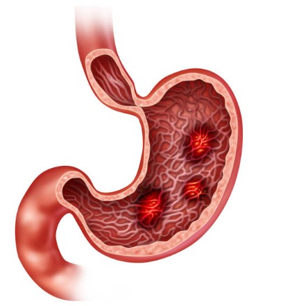위염 증상과 식단 관리 방법 (원인, 음식, 예방법)