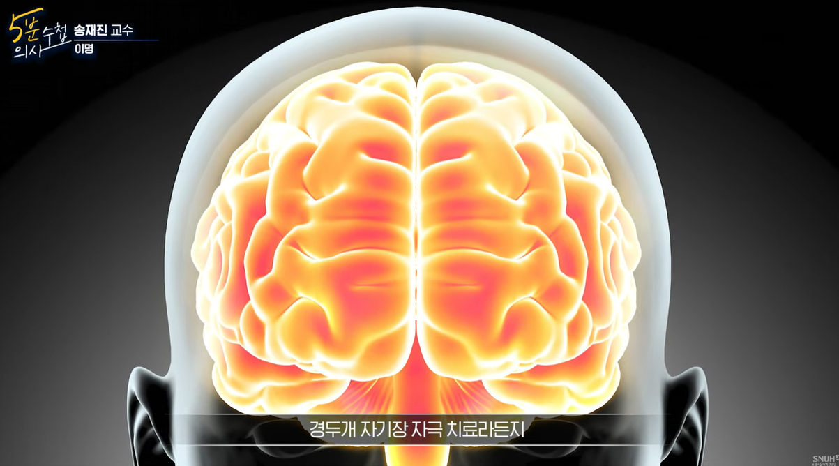 경두개 자기장 자극 치료