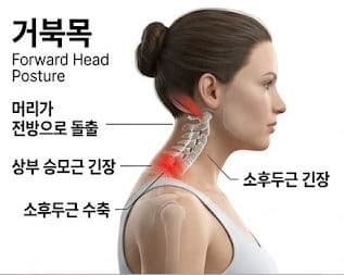 거북목