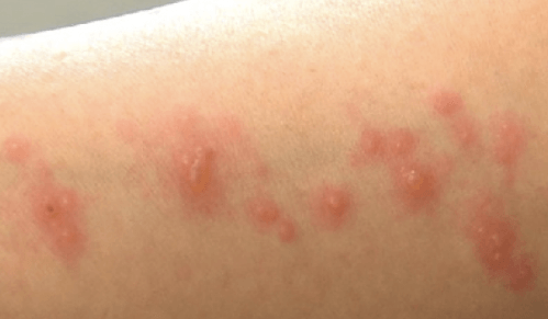 빈대 물린 자국 사진 및 증상