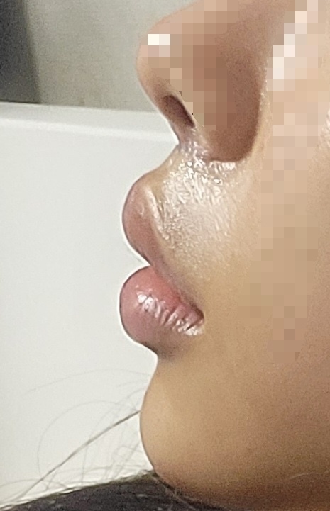 인중 축소 수술 후기