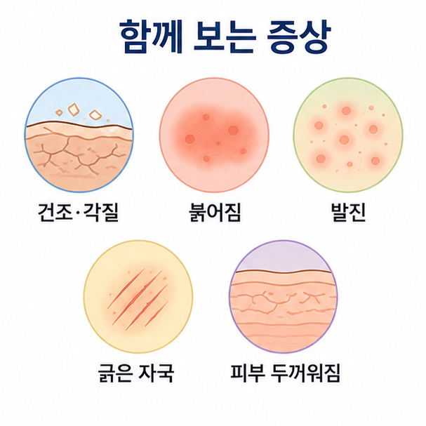 피부 건조와 각질, 붉어짐, 발진, 긁은 자국, 피부 두꺼워짐 등 가려움과 함께 볼 증상을 정리한 이미지