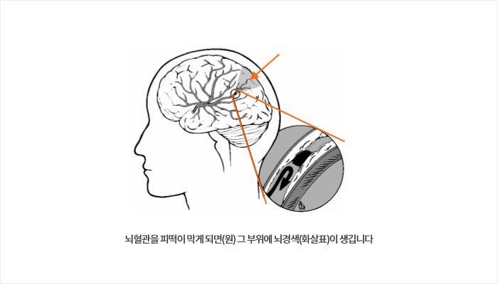 뇌경색6