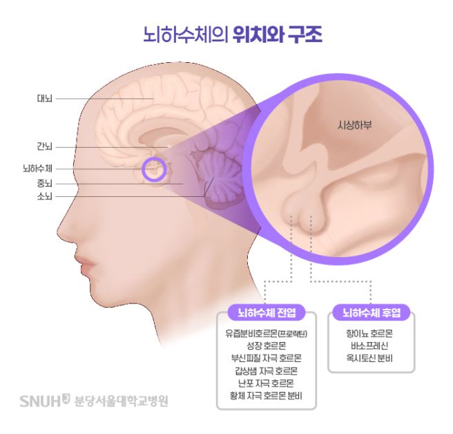 뇌하수체 종양 증상