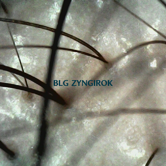 피나모아 복용 23주차 - 정수리와 이마 사이 부분 두피 모습이다.