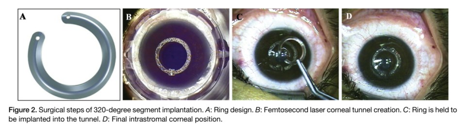 원추각막 링삽입술