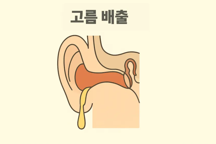 외이도염 증상