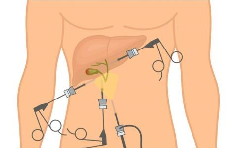 쓸개(담낭) 제거수술