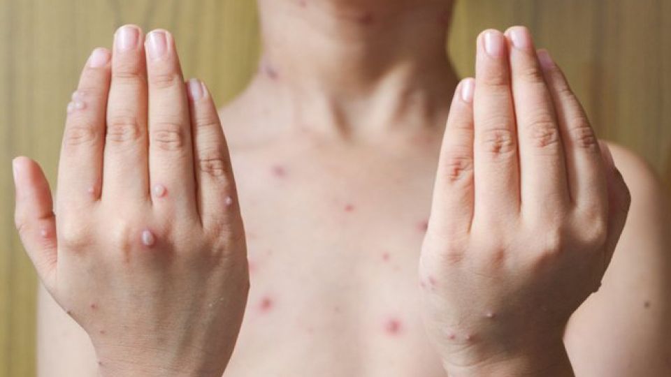 chickenpox symptoms 2