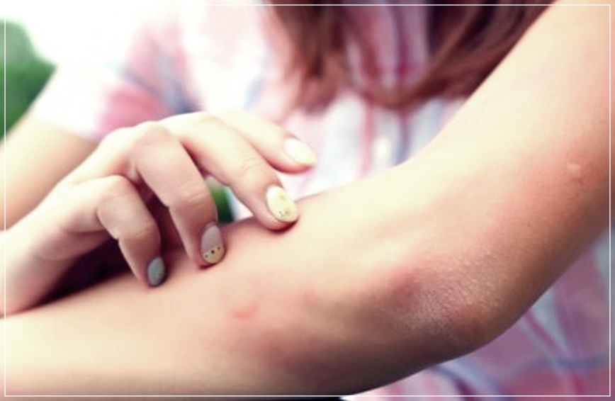 히스타민증후군에 대해 알아보자