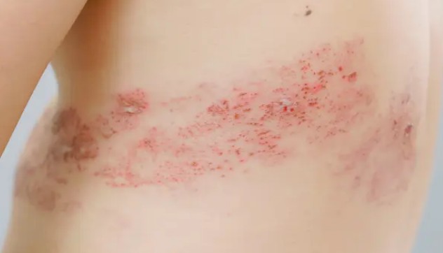 대상포진 초기증상