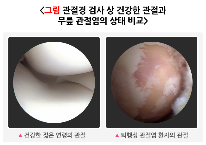 퇴행성관절염 원인, 증상, 예방, 치료방법