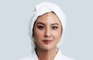 기미 제거 전후