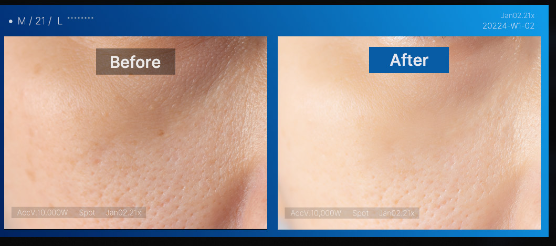 4주 사용으로 인한 피부 탄력 변화