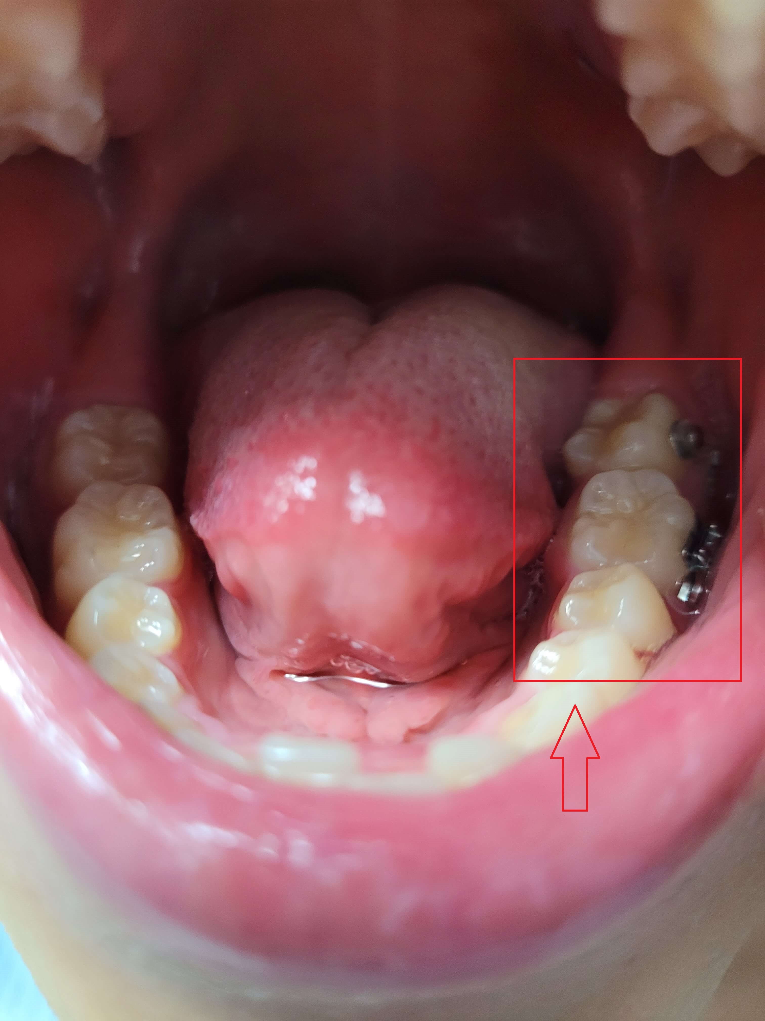 부정교합 가위교합 과개교합 치아교정 후기7