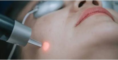 레이저기계로 기미 치료받는 사진