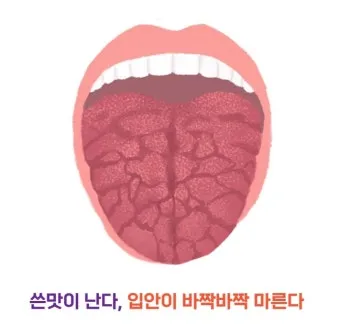 입이 쓴 증상 4가지 원인과 해결방법_2