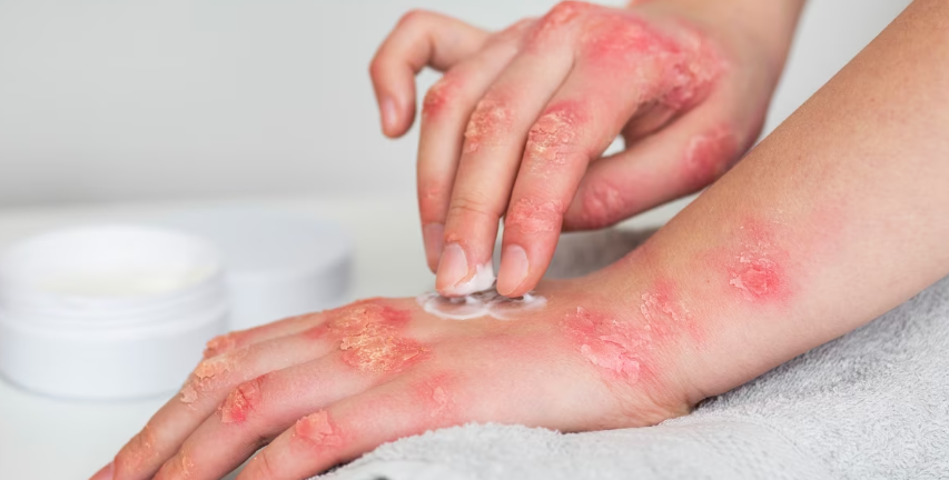 아나팔락시스 예방방법