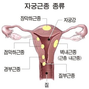 자궁근종 증상