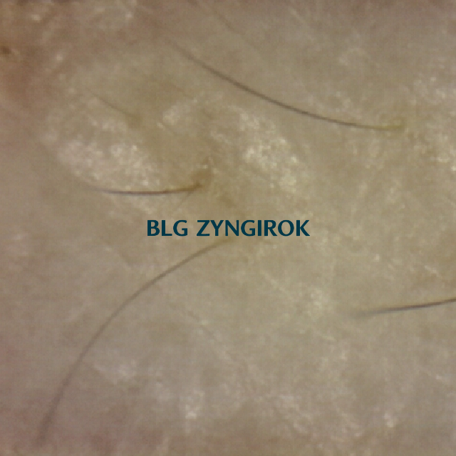 탈모 극복 프로젝트 - 오른쪽 M자 부위 두피 모습이다.